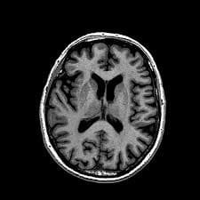 Снимок МРТ Головного мозга